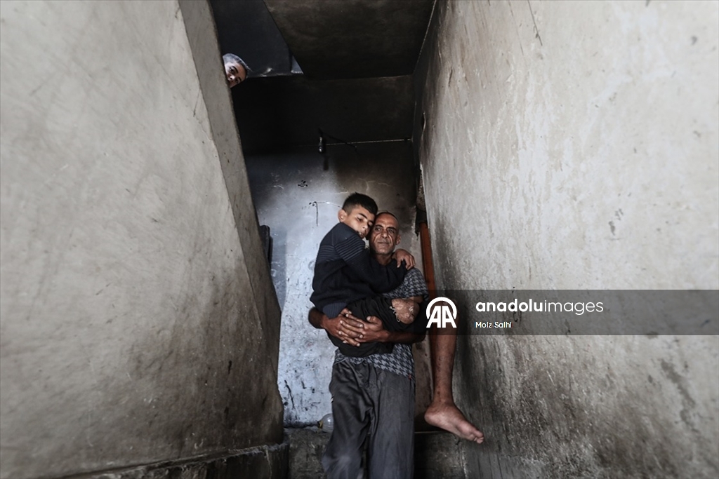 Gazze’de bir bacağını kaybeden Uda’nın diğer bacağı da risk altında