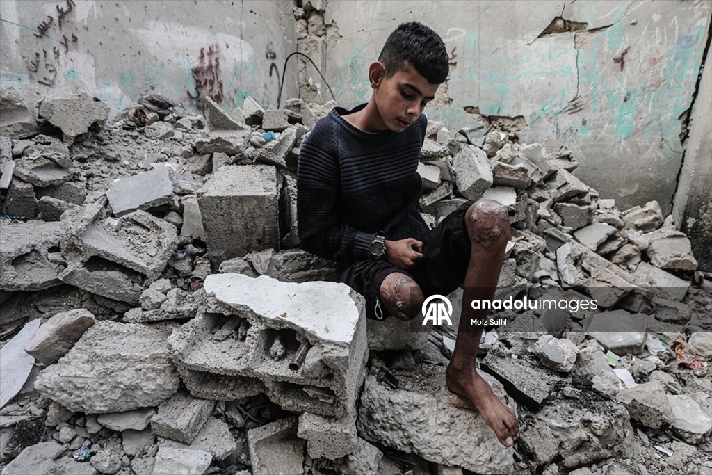 Gazze’de bir bacağını kaybeden Uda’nın diğer bacağı da risk altında