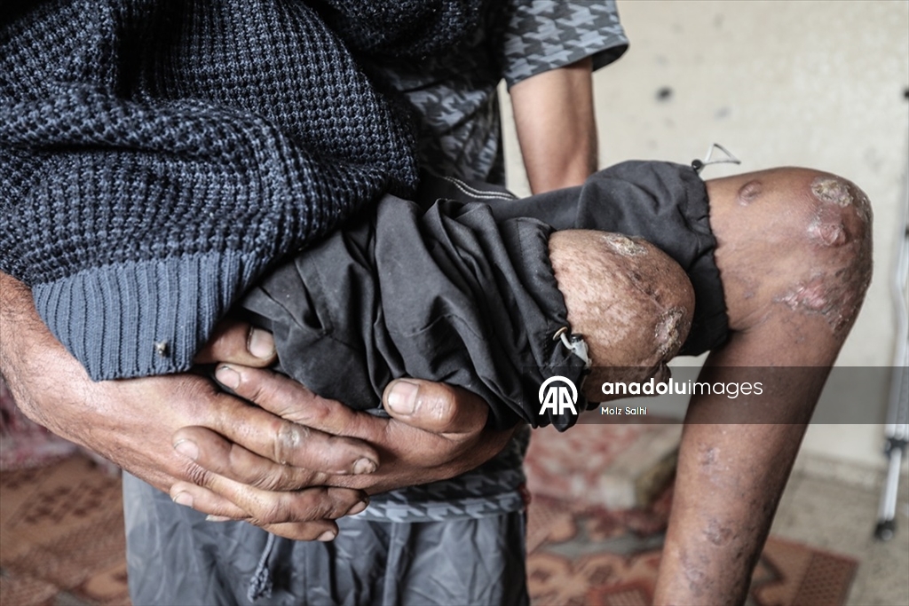 Gazze’de bir bacağını kaybeden Uda’nın diğer bacağı da risk altında