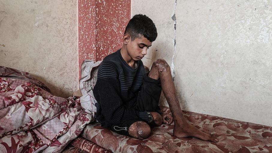 Gazze’de bir bacağını kaybeden Uda’nın diğer bacağı da risk altında