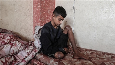 Gazze’de bir bacağını kaybeden Uda’nın diğer bacağı da risk altında