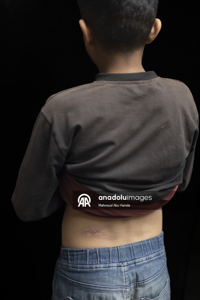 16-летняя палестинка из Газы потеряла семью и обе ноги в результате удара Израиля