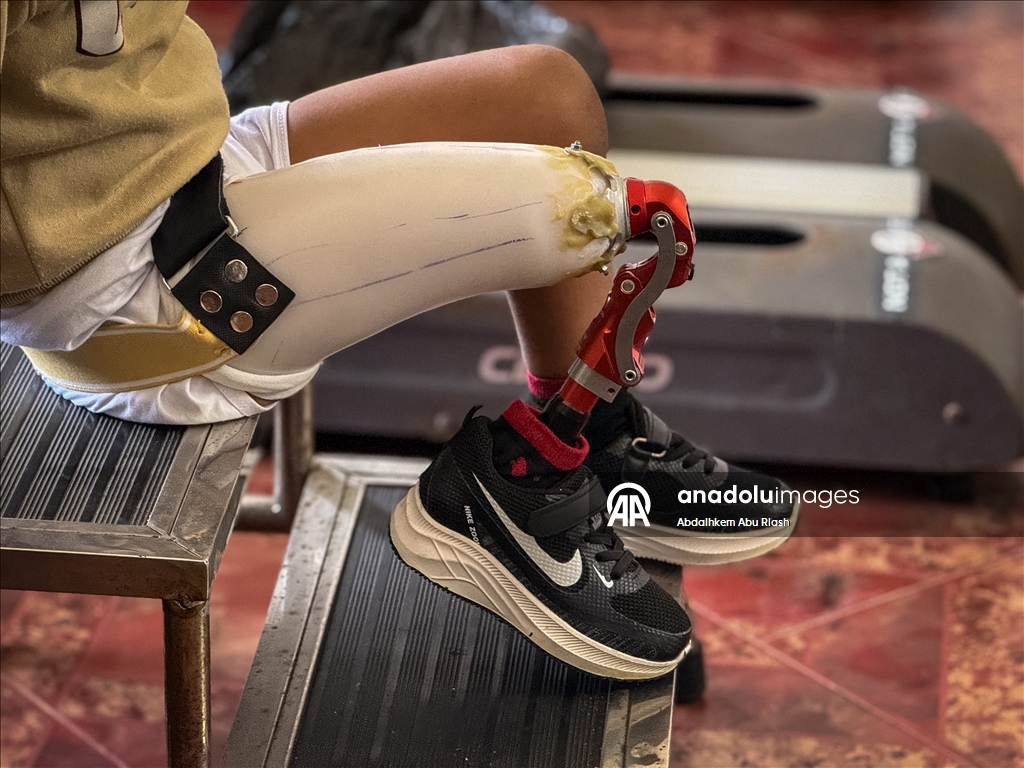 Тысячи палестинцев, потерявших конечности ожидают получения протезов.