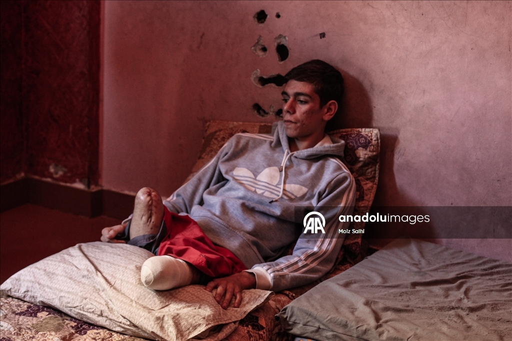 Потерявший обе ноги палестинец надеется на лечение за рубежом