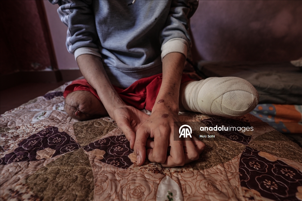 Потерявший обе ноги палестинец надеется на лечение за рубежом