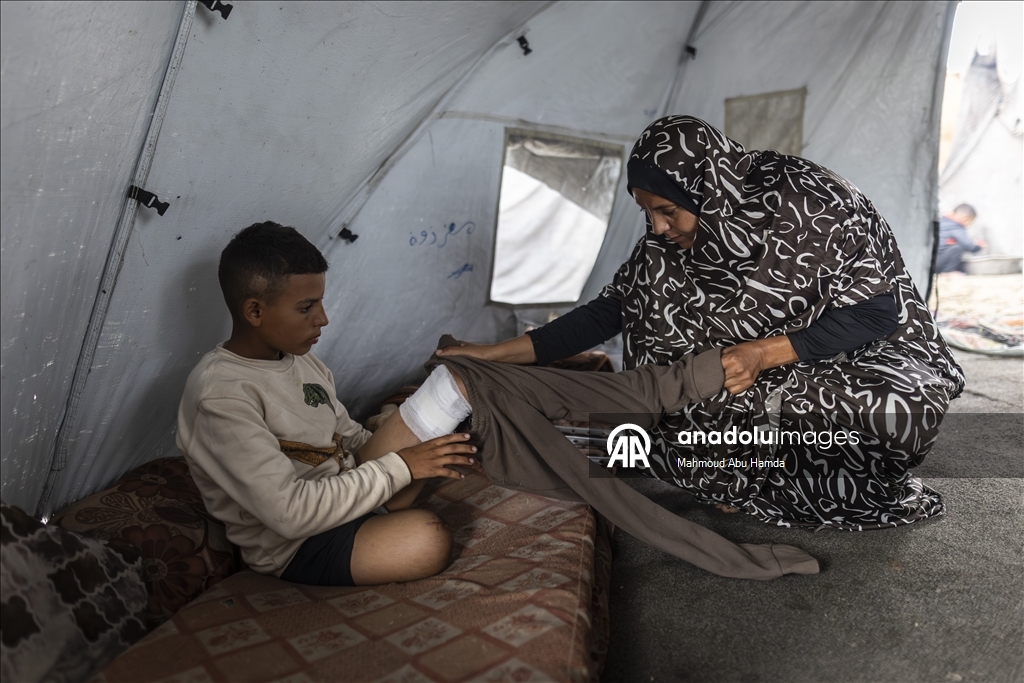 İsrail saldırısında bir bacağını kaybeden Filistinli çocuk ailesinin yardımıyla yaşama tutunuyor