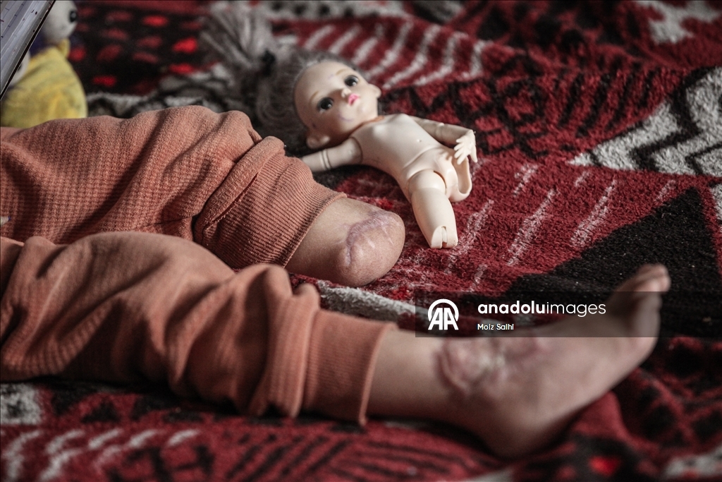 Надежда на протез для 4-летней Раван из Газы