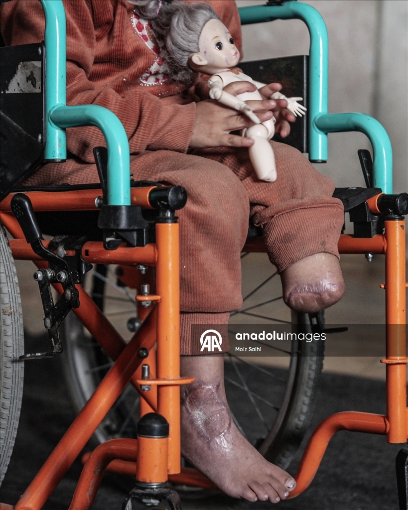 Надежда на протез для 4-летней Раван из Газы