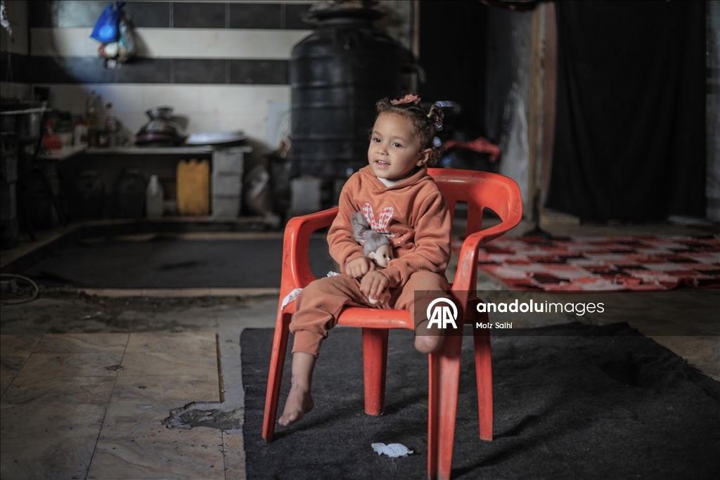 Надежда на протез для 4-летней Раван из Газы