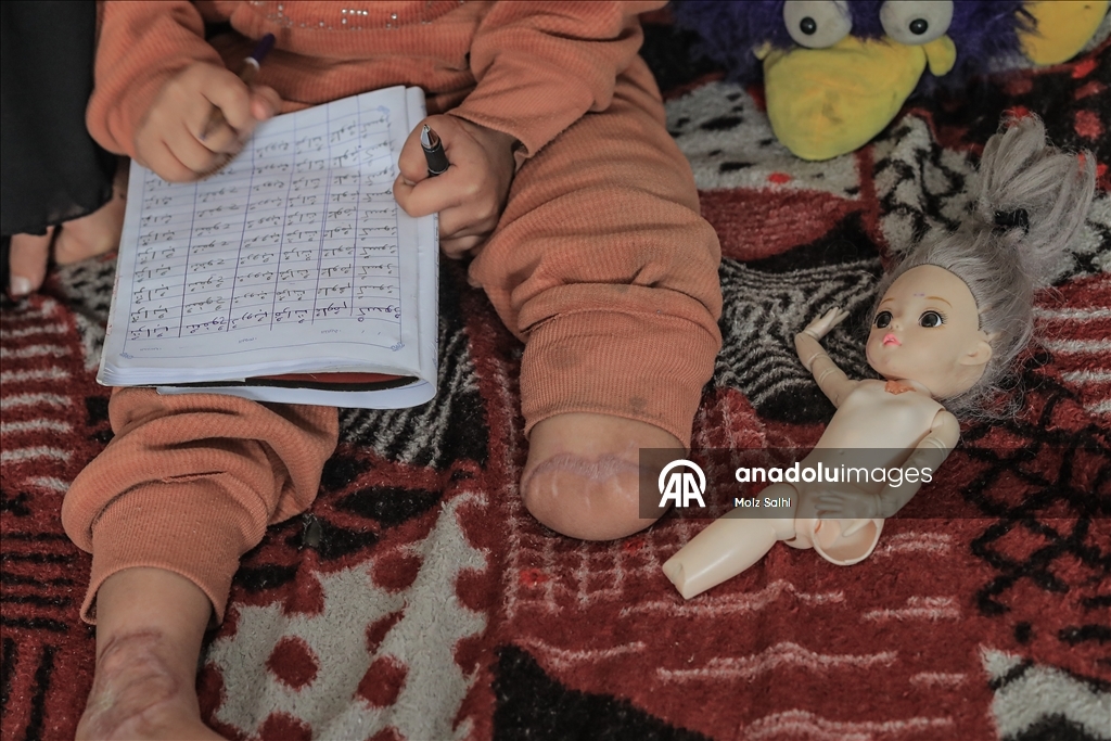 Надежда на протез для 4-летней Раван из Газы