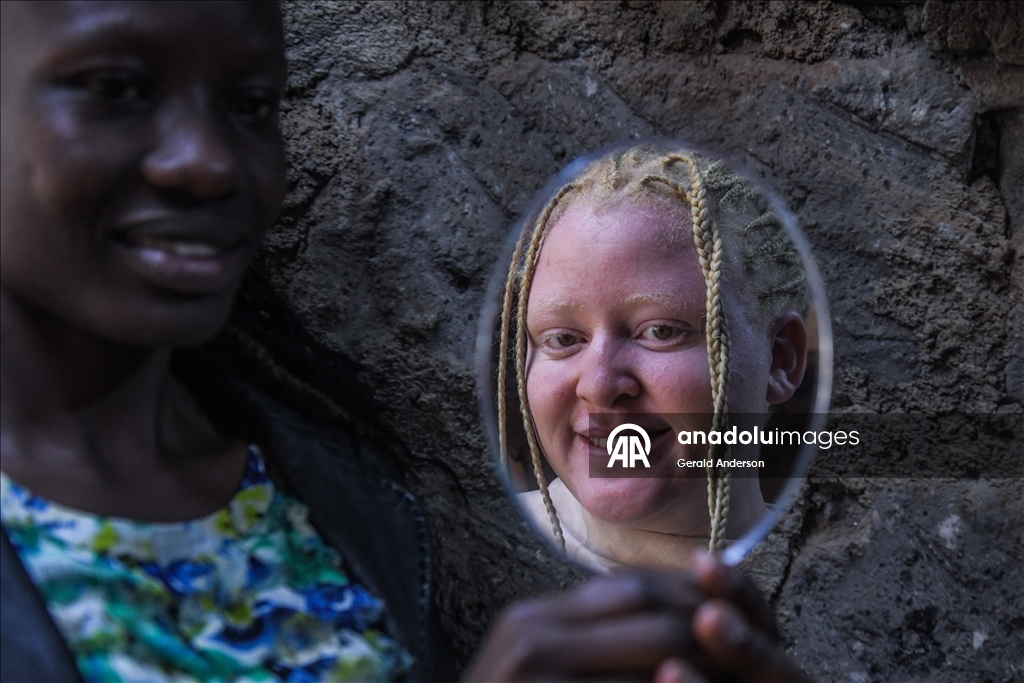 Hem güneşle hem de toplumsal ayrımcılıkla mücadele eden Afrikalı albinolar