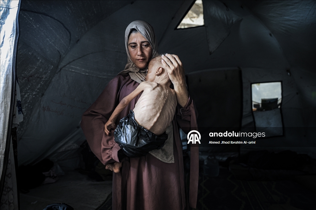 Gazze'de yetersiz beslenme sorunu yaşayan çocuk, ölüm tehlikesiyle karşı karşıya