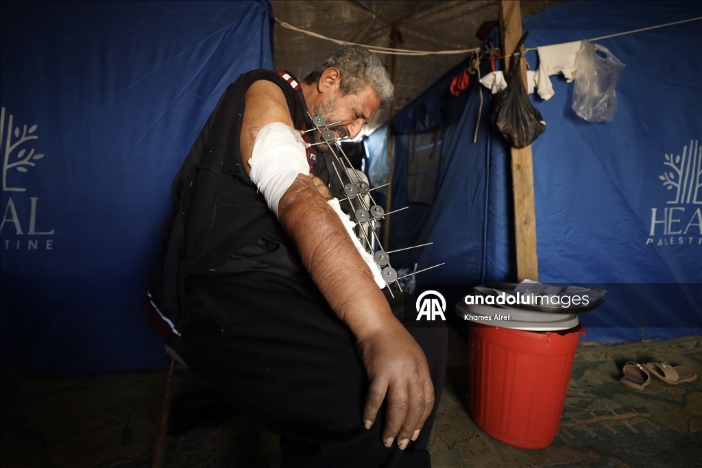 İsrail saldırısında yaralanan Filistinli Zuhayr, zor şartlar altında hayatını sürdürüyor