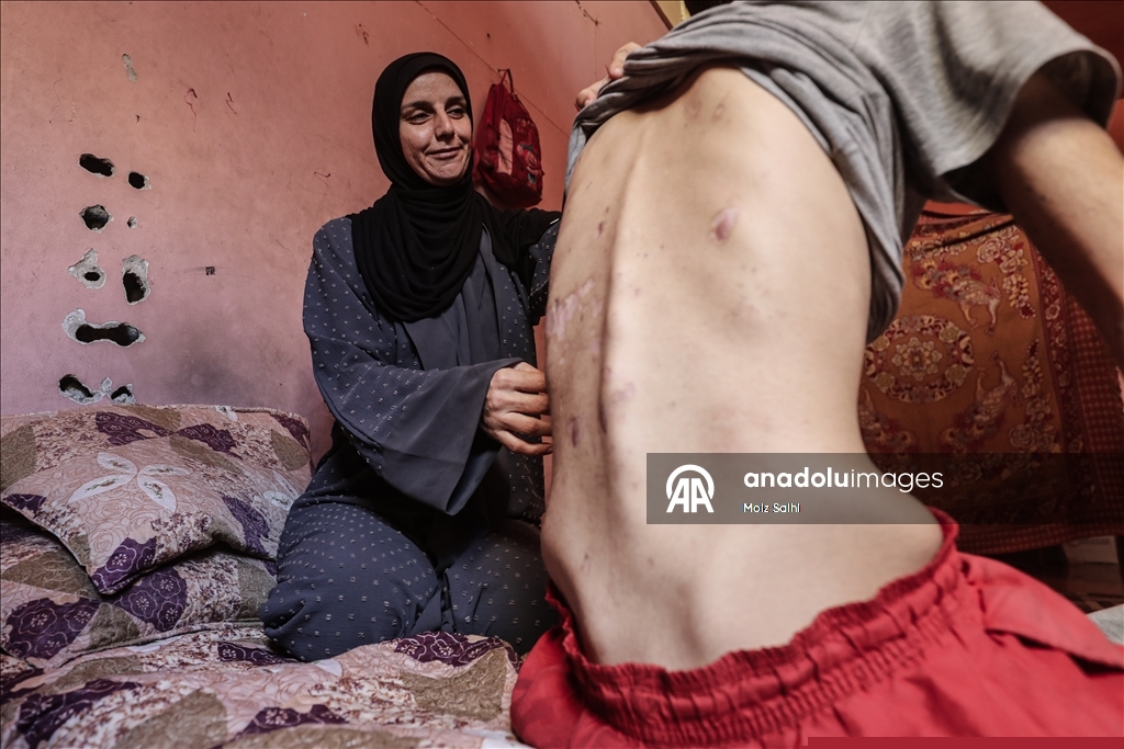 غزة.. لغم إسرائيلي أفقد الشاب داود ساقيه وسلبه أحلامه 