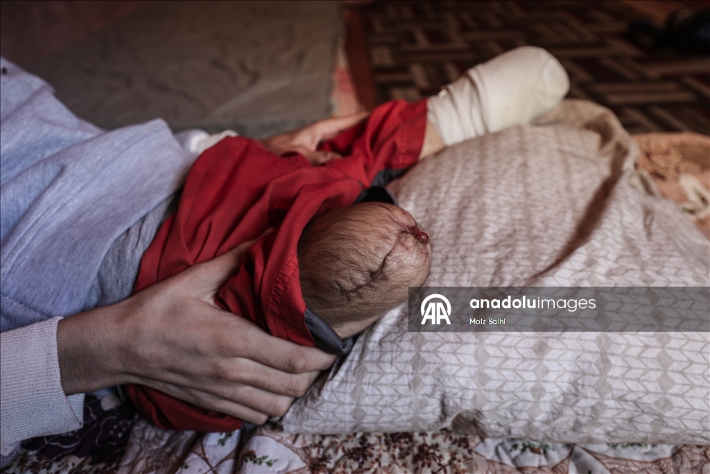 غزة.. لغم إسرائيلي أفقد الشاب داود ساقيه وسلبه أحلامه 