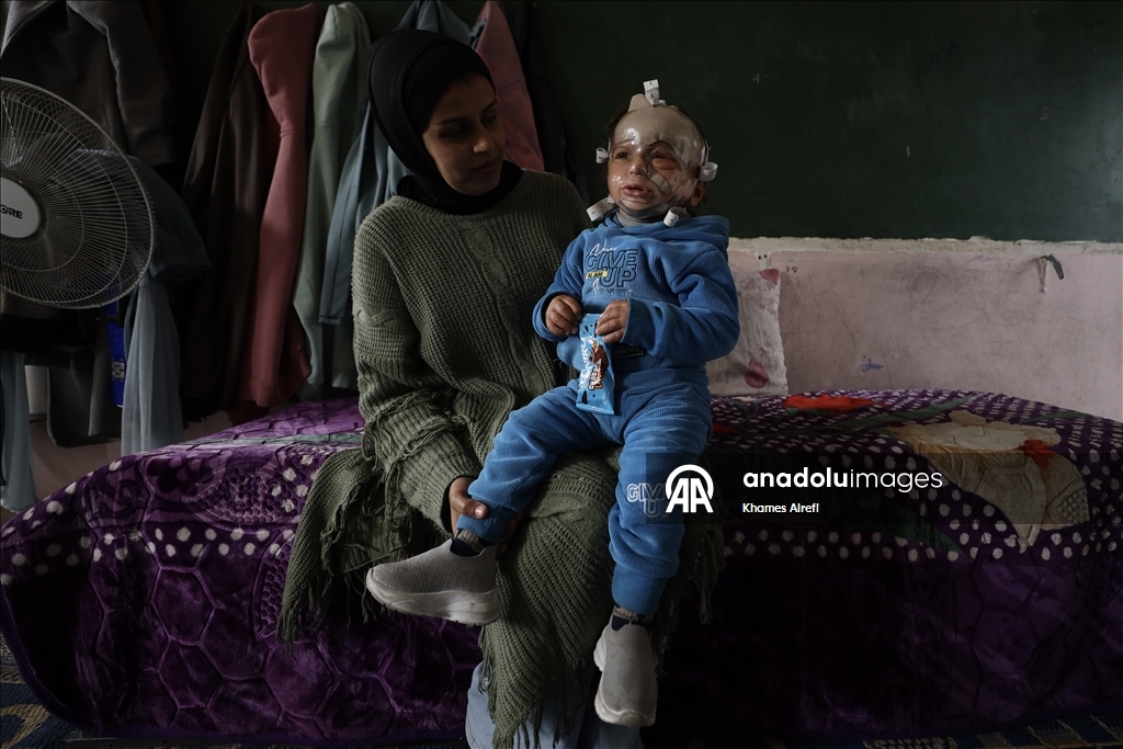 Полуторогодовалый палестинец с тяжелыми ожогами нуждается в срочном лечении после израильского удара по Газе