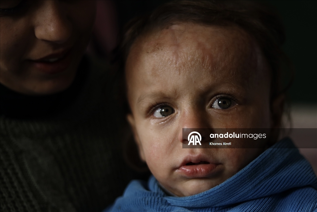 Полуторогодовалый палестинец с тяжелыми ожогами нуждается в срочном лечении после израильского удара по Газе