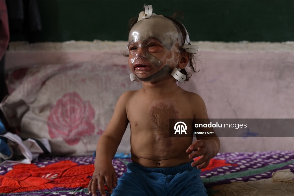 İsrail'in Gazze'ye saldırılarında ağır yaralanan Filistinli çocuk, gerekli tedaviye kavuşmayı bekliyor