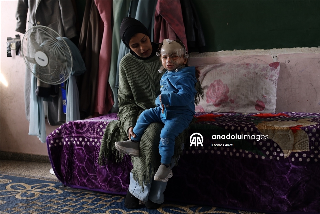 İsrail'in Gazze'ye saldırılarında ağır yaralanan Filistinli çocuk, gerekli tedaviye kavuşmayı bekliyor
