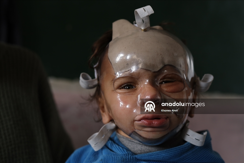 Полуторогодовалый палестинец с тяжелыми ожогами нуждается в срочном лечении после израильского удара по Газе