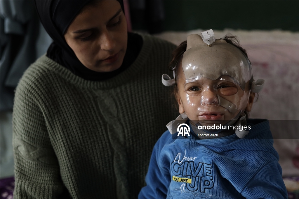 Полуторогодовалый палестинец с тяжелыми ожогами нуждается в срочном лечении после израильского удара по Газе