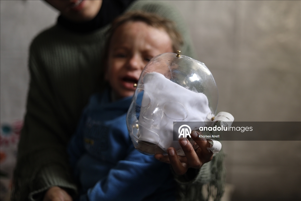 Полуторогодовалый палестинец с тяжелыми ожогами нуждается в срочном лечении после израильского удара по Газе