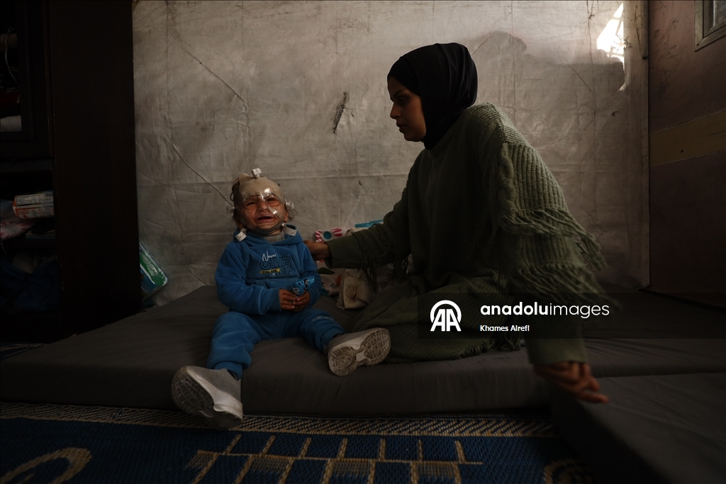 Полуторогодовалый палестинец с тяжелыми ожогами нуждается в срочном лечении после израильского удара по Газе