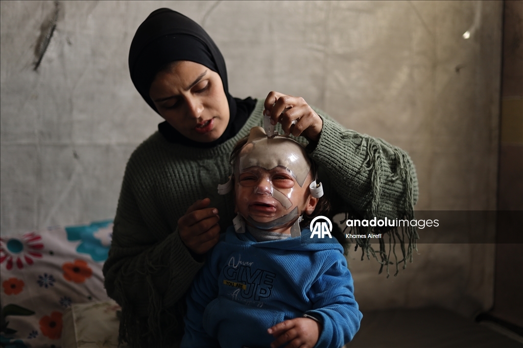 Полуторогодовалый палестинец с тяжелыми ожогами нуждается в срочном лечении после израильского удара по Газе