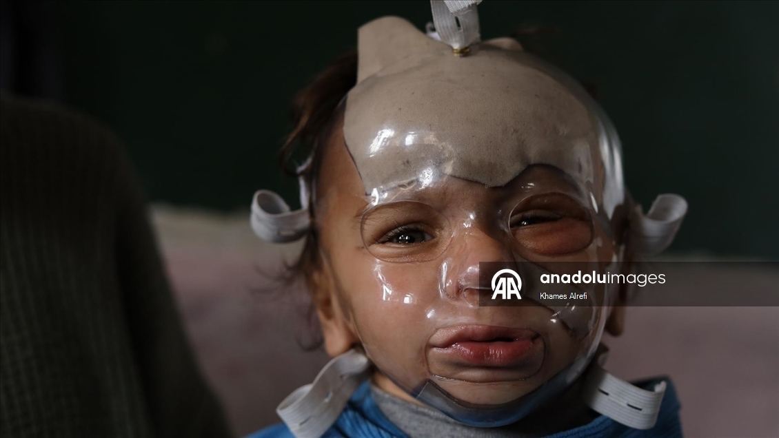 İsrail'in Gazze'ye saldırılarında ağır yaralanan Filistinli çocuk, gerekli tedaviye kavuşmayı bekliyor