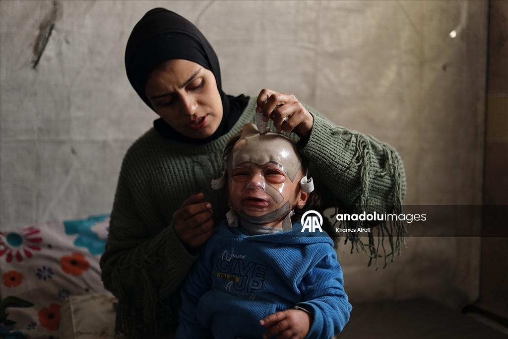 İsrail'in Gazze'ye saldırılarında ağır yaralanan Filistinli çocuk, gerekli tedaviye kavuşmayı bekliyor