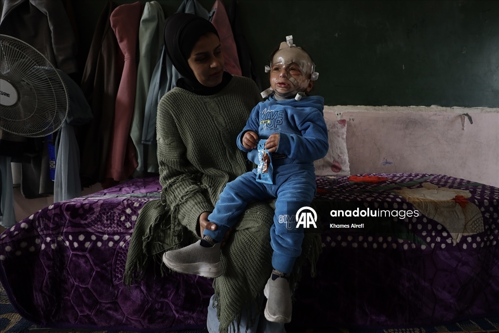 İsrail'in Gazze'ye saldırılarında ağır yaralanan Filistinli çocuk, gerekli tedaviye kavuşmayı bekliyor