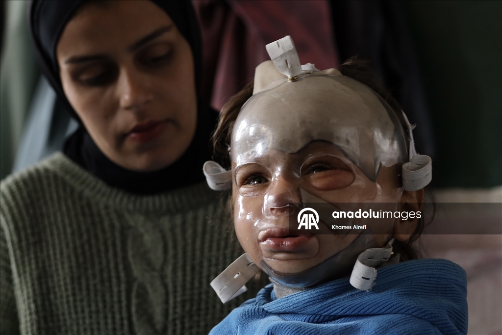 Полуторогодовалый палестинец с тяжелыми ожогами нуждается в срочном лечении после израильского удара по Газе