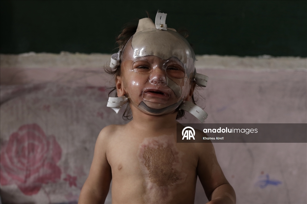 Полуторогодовалый палестинец с тяжелыми ожогами нуждается в срочном лечении после израильского удара по Газе