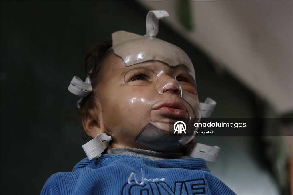 Полуторогодовалый палестинец с тяжелыми ожогами нуждается в срочном лечении после израильского удара по Газе