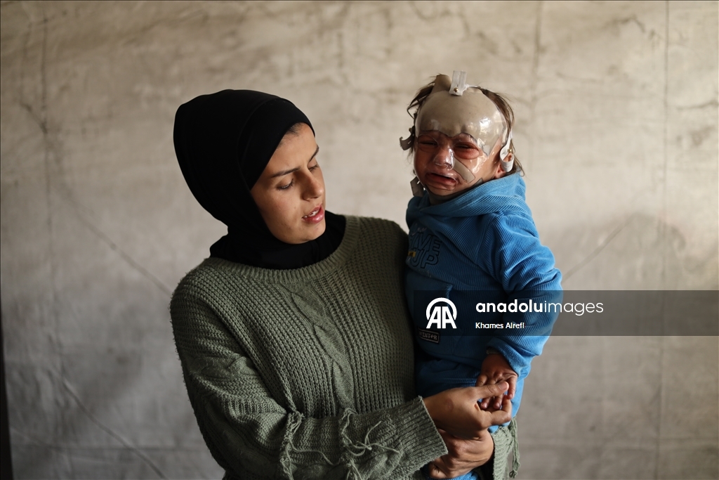 Полуторогодовалый палестинец с тяжелыми ожогами нуждается в срочном лечении после израильского удара по Газе