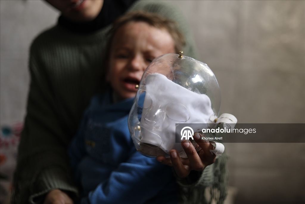 İsrail'in Gazze'ye saldırılarında ağır yaralanan Filistinli çocuk, gerekli tedaviye kavuşmayı bekliyor