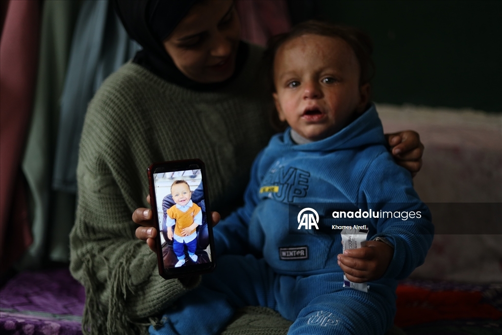 İsrail'in Gazze'ye saldırılarında ağır yaralanan Filistinli çocuk, gerekli tedaviye kavuşmayı bekliyor