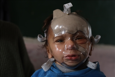 Полуторогодовалый палестинец с тяжелыми ожогами нуждается в срочном лечении после израильского удара по Газе