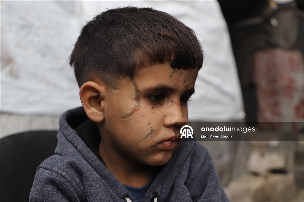 İsrail saldırısında gözlerini kaybeden Filistinli çocuk hayatta kalma mücadelesi veriyor