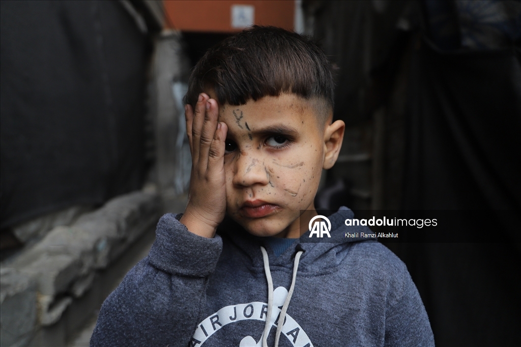 İsrail saldırısında gözlerini kaybeden Filistinli çocuk hayatta kalma mücadelesi veriyor