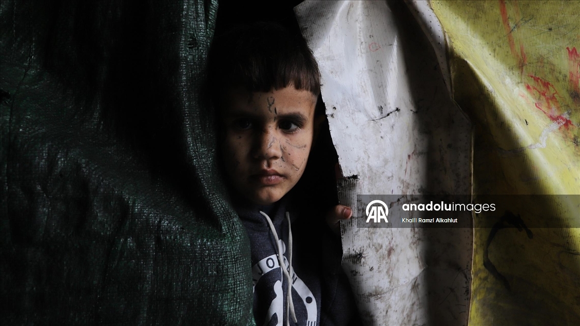 İsrail saldırısında gözlerini kaybeden Filistinli çocuk hayatta kalma mücadelesi veriyor