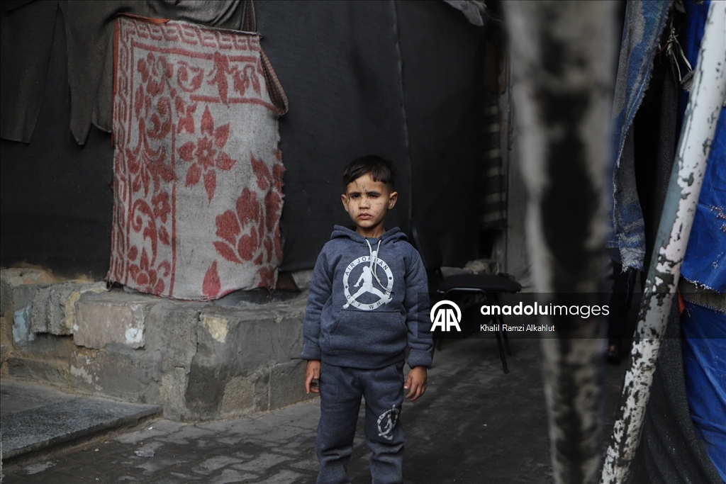 İsrail saldırısında gözlerini kaybeden Filistinli çocuk hayatta kalma mücadelesi veriyor