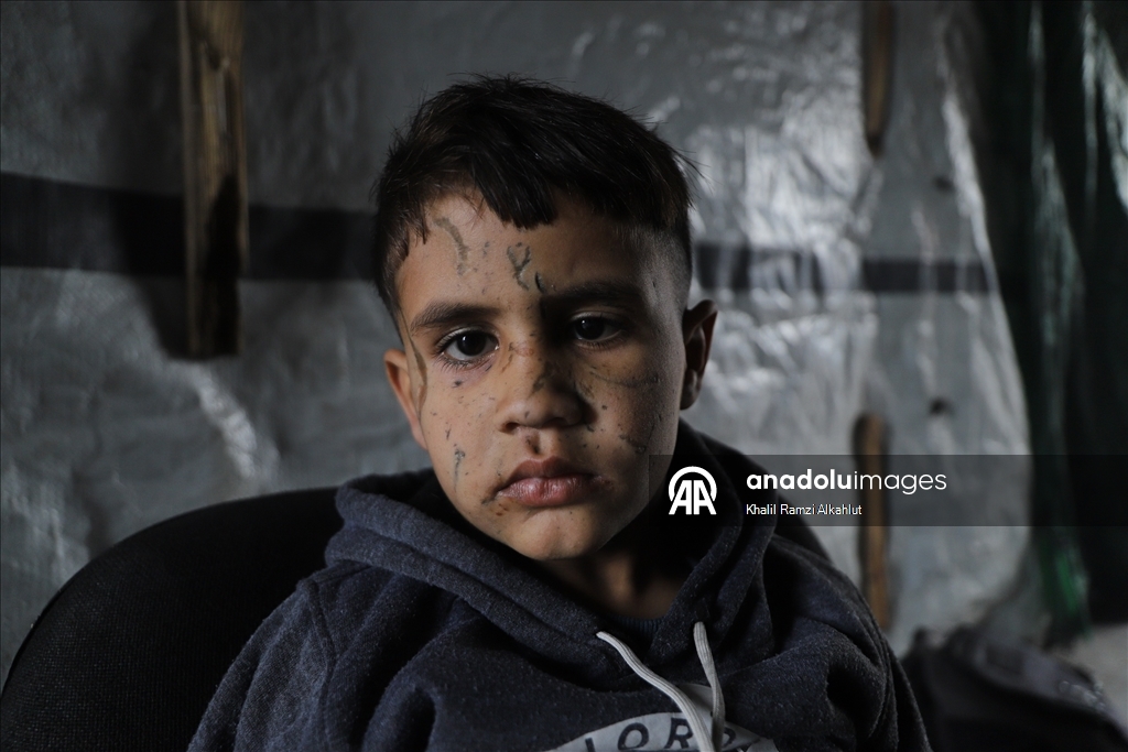 İsrail saldırısında gözlerini kaybeden Filistinli çocuk hayatta kalma mücadelesi veriyor