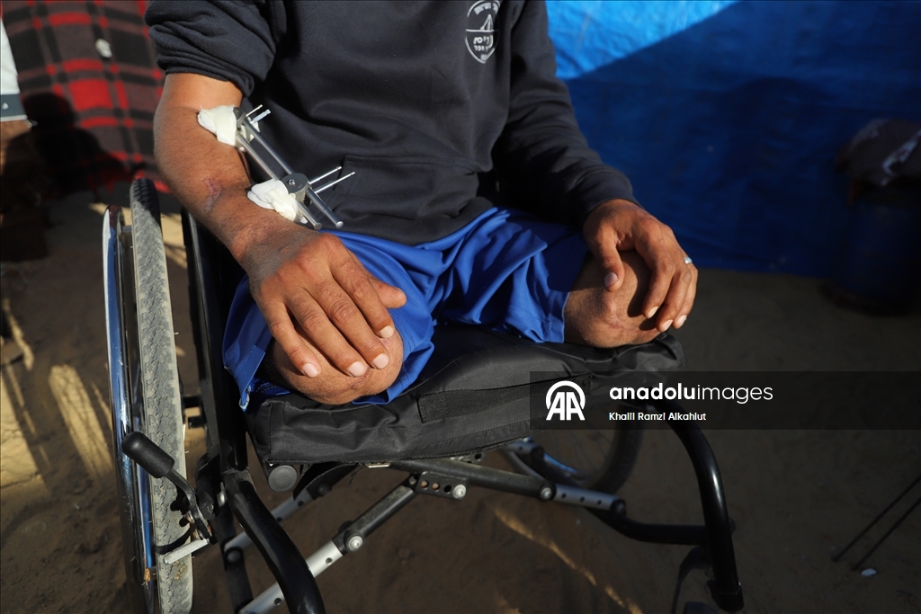 İsrail saldırısında iki bacağını kaybeden Filistinli Alluş, yaşam mücadelesi veriyor