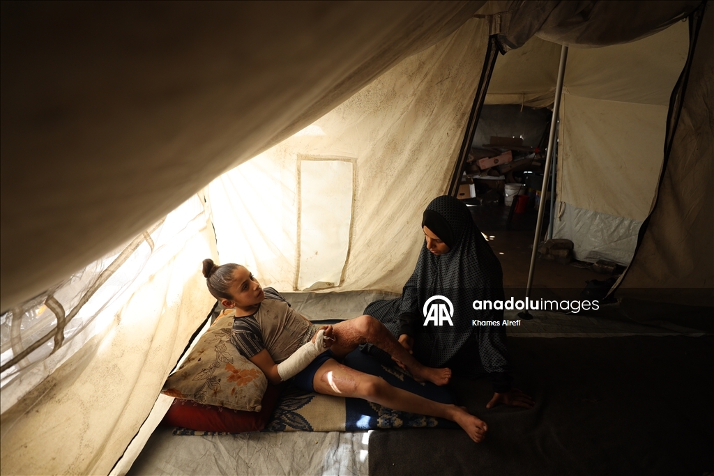 Тяжело раненная в результате израильских атак палестинская девочка испытывает трудности при ходьбе