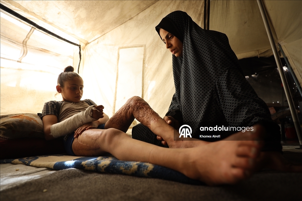 Тяжело раненная в результате израильских атак палестинская девочка испытывает трудности при ходьбе