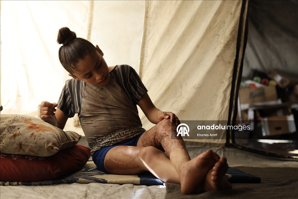 Тяжело раненная в результате израильских атак палестинская девочка испытывает трудности при ходьбе