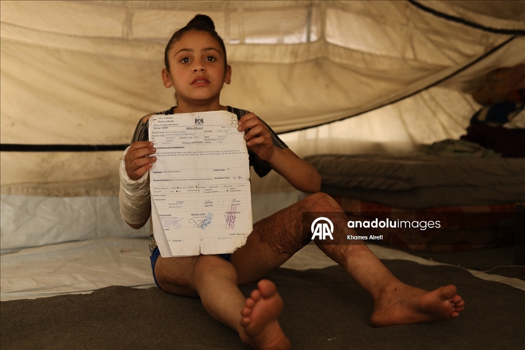 Тяжело раненная в результате израильских атак палестинская девочка испытывает трудности при ходьбе