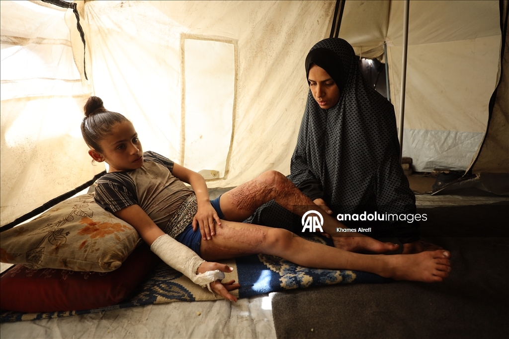 Тяжело раненная в результате израильских атак палестинская девочка испытывает трудности при ходьбе