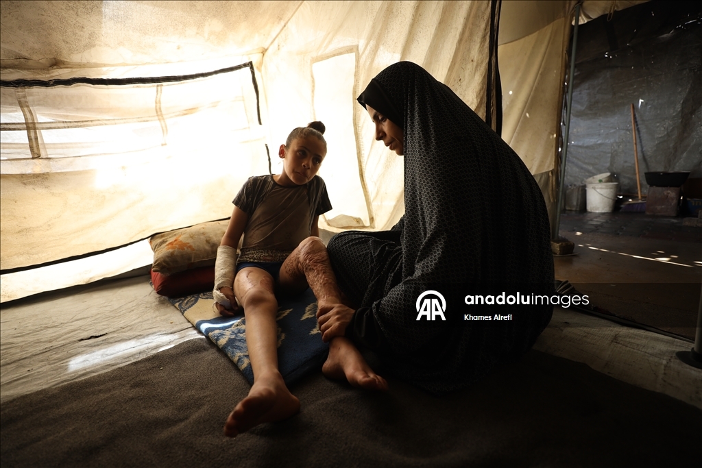 Тяжело раненная в результате израильских атак палестинская девочка испытывает трудности при ходьбе